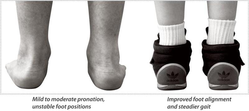With and without the Cascade Dafo Chipmunk Orthotics